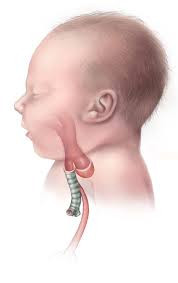 Atresia Esofagus